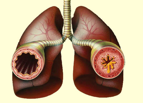 Airway Disease