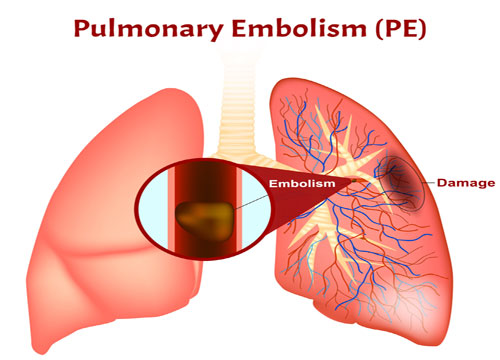 Disease of Pulmonary Circulation