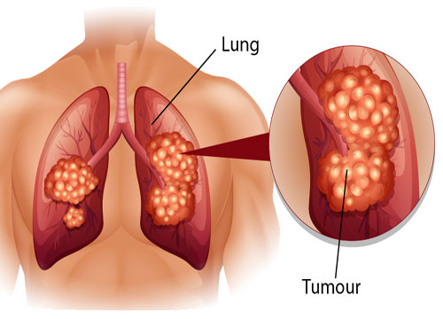 Pulmonary Fibrosis ( Interstitial Lung Disease )